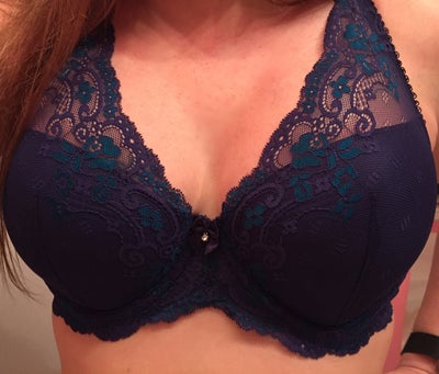 Woman claims tight-fitting underwire bras caused giant cyst, gaping 'hole