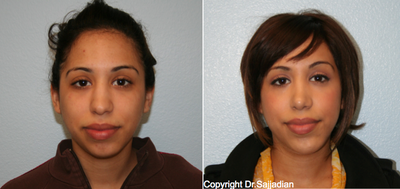 Chin Implant - Chin Implant