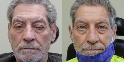 65-74 year old man treated with Ptosis Surgery - Treated with Ptosis Repair Both Upper Lids.