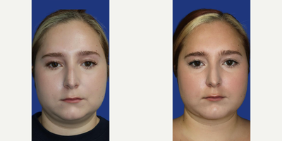 Woman treated with Chin Implant, Chin Liposuction - Thispatient wanted to contour her lower face and neckline, as well as balance out her profile. This was done with a combination of procedures: chin augmentation, neck lipo, and co2 laser to enhance skin quality.Revealing hernew profile, just 1 month post-op*Please note, it takes 3 months to fully recover and some swelling is still visible at this point in recovery.