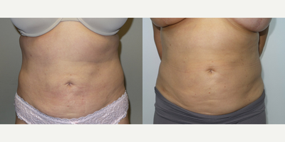 Woman treated with Exilis - Woman treated with Exilis