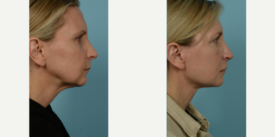 45-54 year old woman treated with Facelift, Lower Facelift, Neck Lift, Facial Fat Transfer, Laser Resurfacing, Dermabrasion - The 54-year-old female patient pictured above was driven by considerable changes of aging, particularly evident in the areas around the jowls and cheeks, thin lips, the early appearance of vertical lines around the mouth, and changes in her neck. This active runner and yoga enthusiast sought out the exceptional Facelift/Minilift by Dr. Mustoe in Chicago, renowned for delivering natural and not overstretched results. The patient was referred by a friend who ten years prior had trusted Dr. Mustoe with a similar surgery.Under IV sedation and local anesthesia, Dr. Mustoe employed a deep plane facelift, fat grafting around the mouth, ablative laser, and spot dermabrasion around the mouth and to her forehead. Her ease throughout the process was likely a result of the widely recognized expertise and care of Dr. Mustoe and his staff at TLKM Plastic Surgery.Post-procedure, the patient's results were dramatically visible in her naturally rejuvenated and fresh appearance. The transformation was balanced, avoiding the appearance of being overstretched, which was crucial for her. Comfort and satisfaction with the Facelift/Minilift by Dr. Mustoe in Chicago was evident in the patient's glowing post-procedure expression, all while retaining the natural characteristics that made her unique. The outcomes bear witness to Dr. Mustoe's excellence, a culmination of over 30 years of experience combined with a prestigious background of education and research from Harvard to advisory positions with the U.S. Food & Drug Administration.
