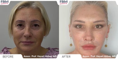 55-64 year old woman treated with Deep Plane Facelift, Facelift, Facial Fat Transfer, Eyelid Surgery, Neck Lift - 55-64 year old woman treated with Deep Plane Facelift, Facelift, Facial Fat Transfer, Eyelid Surgery, Neck Lift