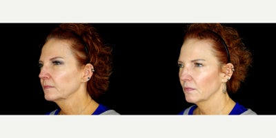 60 year old woman treated with Thread Lift - 60 year old woman treated with Thread Lift. Photos depict before and 3 months after 18 Novathreads