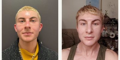 18-24 year old transgender woman treated with Facial Reconstructive Surgery - Facial Masculinization Surgery