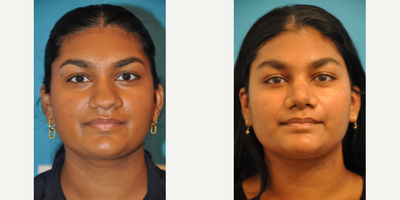 Teenage Rhinoplasty - Teenage Rhinoplasty
