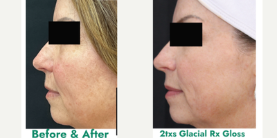 55-64 year old woman treated with Glacial Rx - Post 2 Glacial Rx Gloss treatmentsGenerally clearer, less red and smoother appearing skin after only 2 treatments.