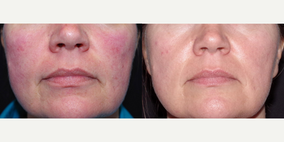 45-54 year old woman treated with Laser Treatment - 48 year old female received Cynosure (IPL) treatment for redness; photos depict the patient's results 6 months post-second treatment.