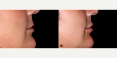 24year old woman treated with Volbella - 24 year old woman treated with Volbella, Lip Fillers. Photos depict before and 1 month after treatment.