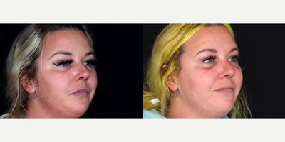 35 year old woman treated with Septoplasty, Rhinoplasty - 35 year old woman treated with Septoplasty, Rhinoplasty. Photos depict before and 2 months after surgery