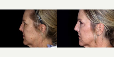54 year old woman treated with Eyelid Surgery, Cheek Lift - 54 year old woman treated with Eyelid Surgery, Cheek Lift. Photos depict before and 6 months after surgery.