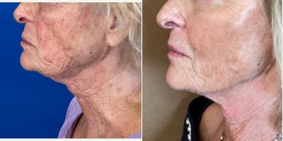 75 and up year old woman treated with Cheek Fillers, Laser Liposuction, Nonsurgical Facelift, Miracu, Nonsurgical Neck Lift, Rad - Facial Rejuvenation in the hands of Dr. Jeffrey Rosenthal, requires a combination of procedures to stimulate collagen with the Endolift Laser, Lift and support sagging face, jaw and neck skin with PDO Threads (Miracu and Mint) and replace lost volume with Radiesse and RHA fillers. Harmony and Balance of the face and neck is the ideal rejuvenation.