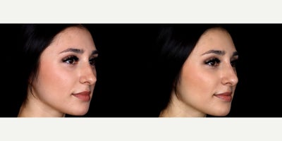 24 year old woman treated with Vollure, Nonsurgical Nose Job - 24 year old woman treated with 0.7 syringe of Vollure, Nonsurgical Nose Job. Photos depict before and immediately after treatment.