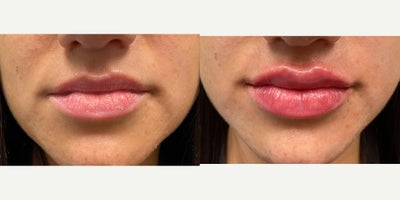 25-34 year old woman treated with Restylane Kysse - Restylane Kysse lip fillers with Dr. Wise at the Wise Center for Plastic Surgery in Wayne, NJ to create a plumped up and symmetrical look!