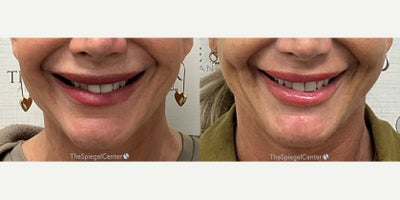 55-64 year old woman treated with Dimple Surgery - Dimpleplasty