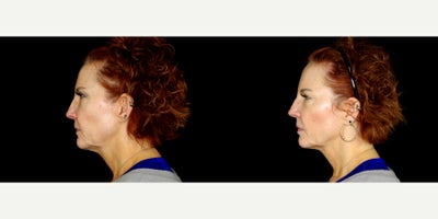 60 year old woman treated with Thread Lift - 60 year old woman treated with Thread Lift. Photos depict before and 3 months after 18 Novathreads