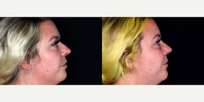 35 year old woman treated with Septoplasty, Rhinoplasty - 35 year old woman treated with Septoplasty, Rhinoplasty. Photos depict before and 2 months after surgery