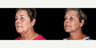 65 year old woman treated with Facelift, Neck Lift, Eyelid Surgery, Cheek Lift, Facial Fat Transfer - 65 year old woman treated with Facelift, Neck Lift, Eyelid Surgery, Cheek Lift, Facial Fat Transfer. Photos depict before and 3 months after surgery.