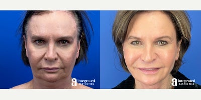 55-64 year old woman treated with AccuTite - This patient is a 56-year-old female who had concerns with her lower face and neck. Dr. Cho performed MyEllevate and accutite. After photos are 3 months post procedure.