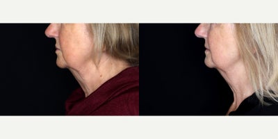 73 year old woman treated with Juvederm, Restylane - 73 year old woman treated with 2 syringes of Juvederm Ultra Plus XC To Nasal Labial Folds and 1 syringe of Restylane to perioral.