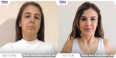 45-54 year old woman treated with Brow Lift, Eyelid Surgery, Buccal Fat Removal, Lip Lift, Facial Fat Transfer - This patient was treated with a Brow lift, upper and lower eyelids, buccal fat removal, lip lifting, and facial fat transfer. After one year of the operation, she got the final result. She was happy to share her photos.