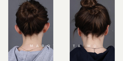 Woman treated with Ear Surgery - One of our awesome patients six months post-otoplasty!What is Otoplasty?Otoplasty is a surgical procedure designed to reshape and reposition the ears. For many, its a transformative journey towards increased self-esteem and confidence.The Journey: Before & AfterWitness the remarkable transformation of a young girl who embraced otoplasty with Dr. Marotta. Swipe left to see the incredible before-and-after images.Why Choose Marotta MD?Dr. Marottas precision and artistry in otoplasty reflect his commitment to enhancing natural beauty. With a wealth of experience, his approach combines technical expertise with a deep understanding of each patients unique needs.Your path to confidence starts here. Ready to explore the possibilities? Take the first step towards newfound confidence. Schedule a consultation with Marotta MD today.