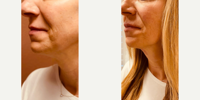 Woman treated with Nonsurgical Facelift - Evoke after 2 treatments