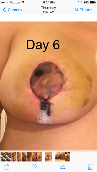 How Long For The Drainage From Breast Reduction To Heal 47