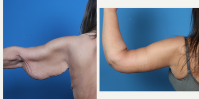 45-54 year old woman treated with Arm Lift - Brachioplasty with excess skin/tissue from 200 pound weight loss excised.
