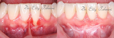 16 year old female treated with Frenectomy and Gum Graft - Young female patient with recession on the two lower front teeth caused by frenum pull (tissue tag or lip pull) and aggressive brushing.&nbsp; The site was treated with frenectomy and gum graft (from the palate) to cover the exposed roots.