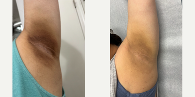 35-44 year old woman treated with Chemical Peel - patient treated with 1 Vi-Peel