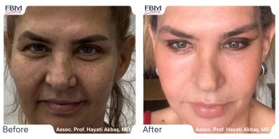 45-54 year old woman treated with Facelift, Deep Plane Facelift, Facial Fat Transfer, Neck Lift, Eyelid Surgery - 45-54 year old woman treated with Facelift, Deep Plane Facelift, Facial Fat Transfer, Neck Lift, Eyelid Surgery