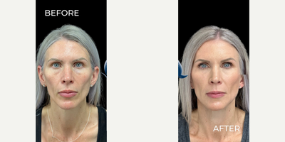 Woman treated with Dermal Fillers - Woman treated with Dermal Fillers