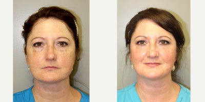 45-54 year old woman treated with Fractional Laser - This patient desired facial rejuvenation and pigment correction.