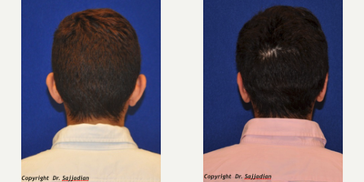 Ear Surgery - Ear Surgery