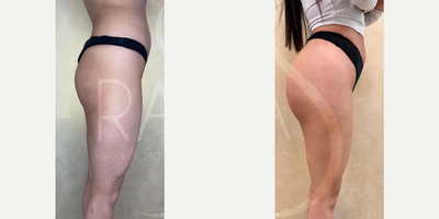 Woman treated with Butt Implants - Woman treated with Butt Implants