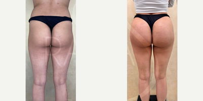 Woman treated with Butt Implants - Woman treated with Butt Implants