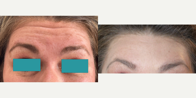 45-54 year old woman treated with Jeuveau - Classic upper face botulinum toxin treatment