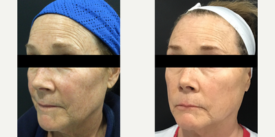 55-64 year old woman treated with VI Peel and Morpheus8 - A series of 3 treatments of VI Peels and 2 Morpheus* treatments. Clearer, brighter skin that's lifted. Client has never had Botox or dermal fillers.
