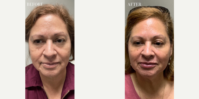 Woman treated with Dysport - Woman treated with Dysport