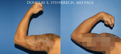 Man treated with Bicep Implants - Man treated with Bicep Implants