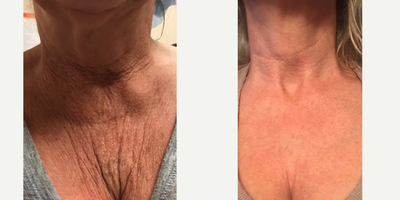 55-64 year old woman treated with Fractional Laser - Before & After ONLY 2 Treatments with Cynosure Icons 1540 Fractional Resurfacing! This treatment penetrates through your dermis & epidermis, damages the tissue to trigger a wound healing response, then heals without any crazy downtime. The healing process rebuilds your own collagen, elastin, & fibroblasts to help smooth out fine lines, wrinkles, stretch marks, scars, discoloration, large pores, & more!