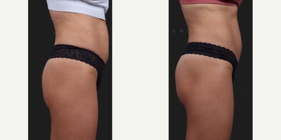 Woman treated with Sculptra Butt Lift, Nonsurgical Butt Lift - Woman treated with Sculptra Butt Lift, Nonsurgical Butt Lift