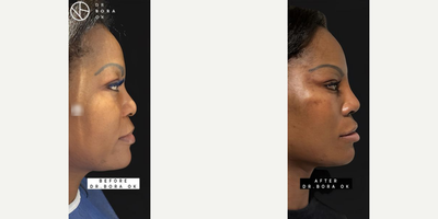 Woman treated with Mini Facelift, Rhinoplasty - Woman treated with Mini Facelift, Rhinoplasty
