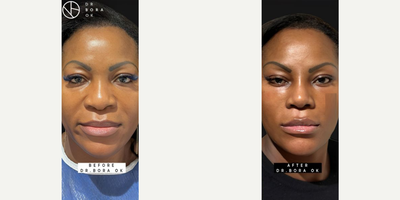 Woman treated with Mini Facelift, Rhinoplasty - Woman treated with Mini Facelift, Rhinoplasty