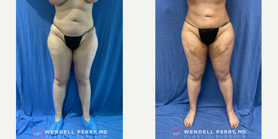 35-44 year old woman treated with Brazilian Butt Lift Revision - This patient wanted a more natural appearing figure.  She wanted a smaller waist and a flatter stomach.