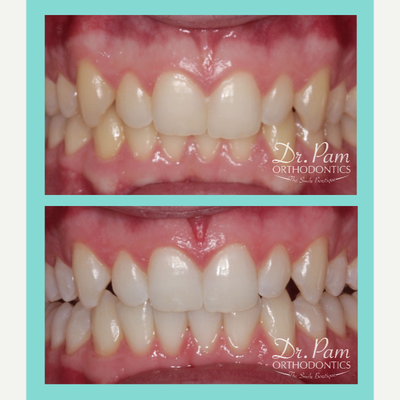 25-34 year old man treated with Zoom Whitening - Check out the results from our in-office ZOOM Whitening procedure -- a brighter smile in just one hour!