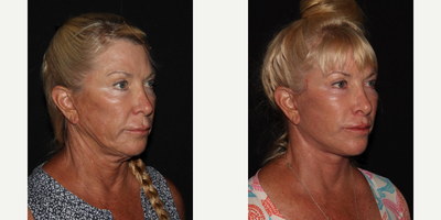 55-64 year old woman treated with Facelift, Laser Resurfacing, Lip Lift - MD Restore, Deep-Plane (Additional Procedures: Laser Resurfacing, Lip Lift)