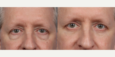 55-64 year old man treated with Lower Eyelid Surgery - Lower Eyelid Blepharoplasty
