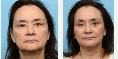 55-64 year old woman treated with Chin Implant - This 62 year-old-patient wanted full facial rejuvenation to reverse the signs of aging. Dr. Wise performed a combination of a deep plane facelift, CO2 laser, upper and lower blepharoplasty, and chin augmentation to address sagging jowls, laxity, sunken eyes, under eye bags, and a small, receded chin. 3 months post-op, she looks and feels youthful with improved contours of the neck and jawline, a balanced profile, smoother and awakened eyes, and a smooth, even complexion.